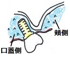 口蓋側に傾斜