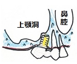 前方下方に埋入