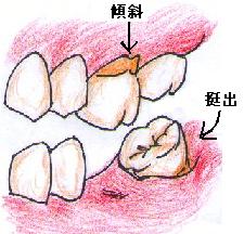 傾斜・挺出
