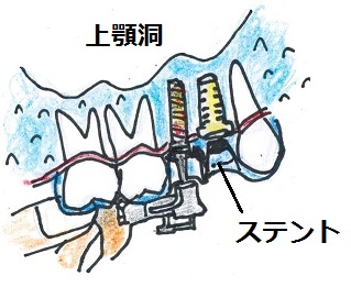 ステント入りでインプラント埋入