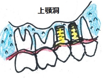 メタルボンド装着