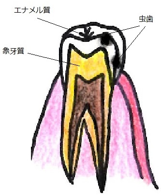 子供の虫歯