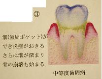 中等度歯周病
