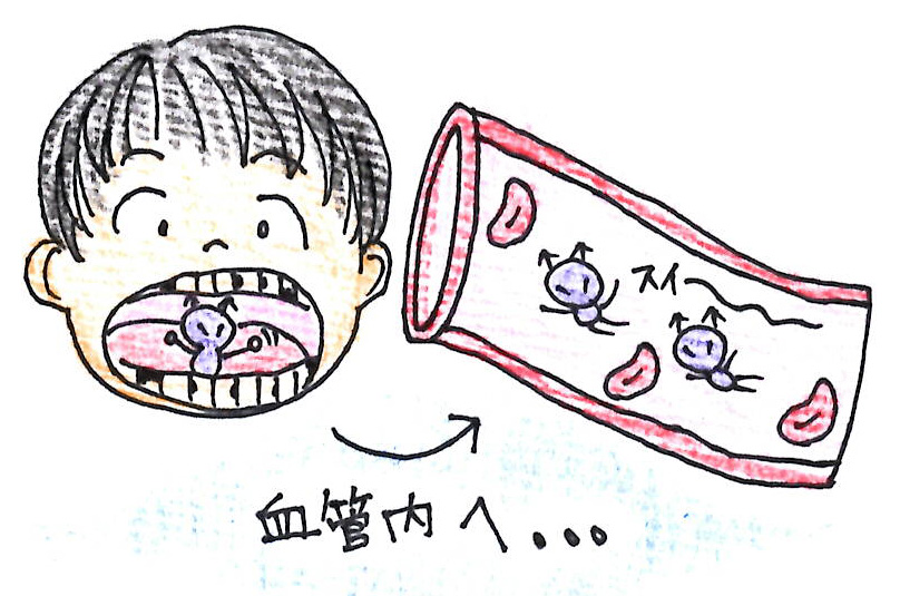 小児歯科 虫歯菌が関係する体の病気