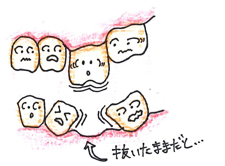 歯を抜いたままにしておくと