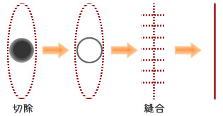 ホクロの切除縫合