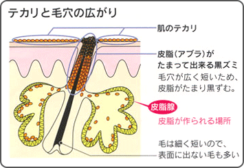 Tゾーンのテカリと毛穴の広がりの説明図