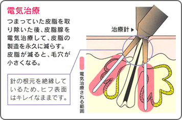 電気治療の説明図