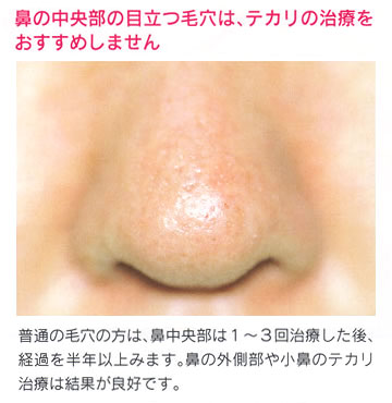 鼻中央部の治療写真