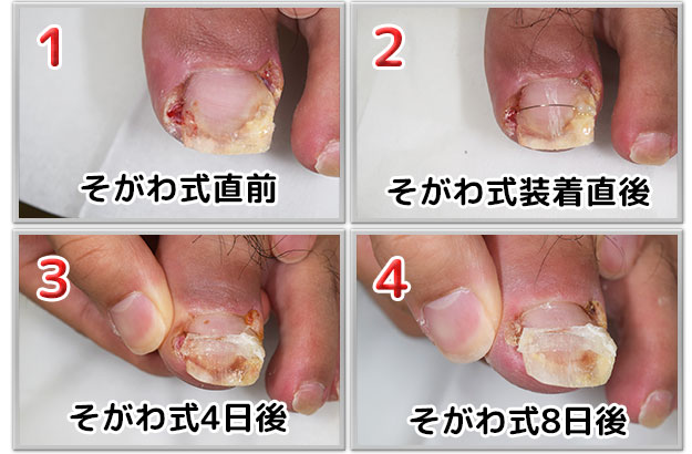 そがわ式陥入爪･巻き爪矯正法(SH法)施術経過