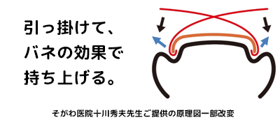 そがわ式陥入爪･巻き爪矯正法(SH法)の原理