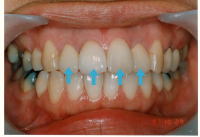 メタルボンドクラウン治療後　変色、歯列不整を改善