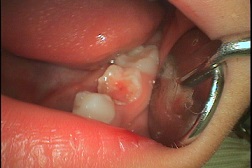 歯髄ポリープ